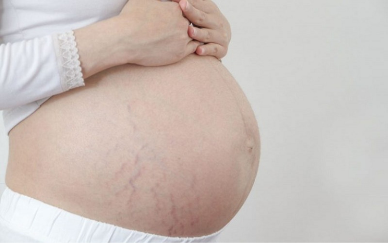 Phụ nữ mang thai dễ bị rạn da