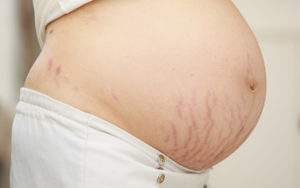 Mang thai là nguyên nhân hàng đầu gây rạn da
